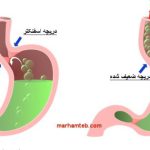 Acidification and gastric reflux from the point of view of traditional medicine